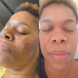 Acne Treatment Facial