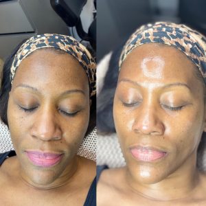 Chemical Peel (Casmara)