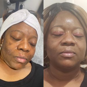 Chermical Peel Level I