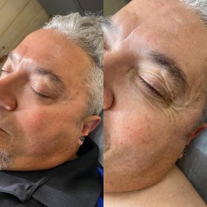 Facial Lifting (Cold Pressure)