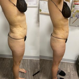 Lymphatic Drainage Massage