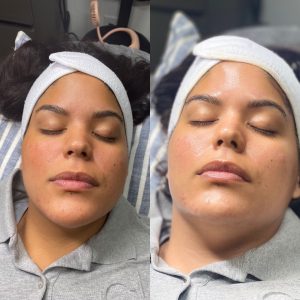 Microdermabrasion + Chemical Peel