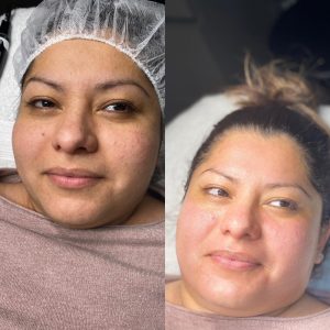 Microneedling Facial