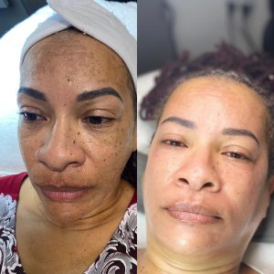 Brightening & Lighten Facial