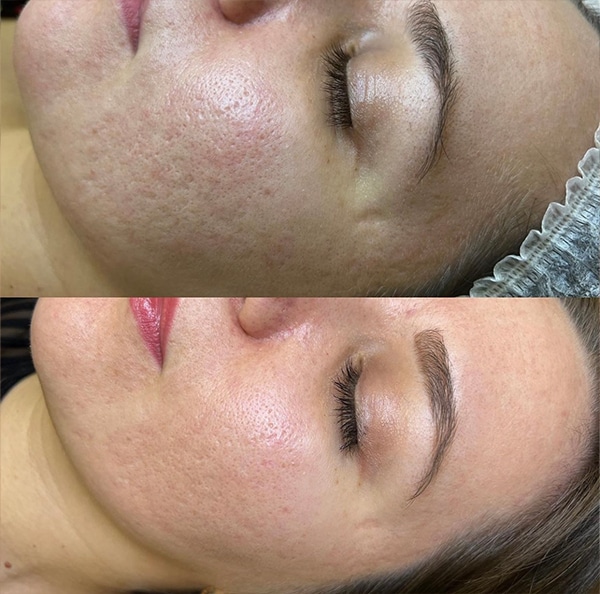 Erbium Yag Before and After